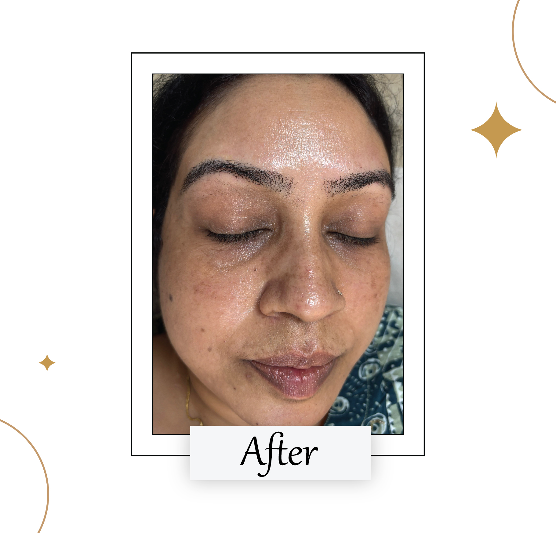 After Chemical Peel