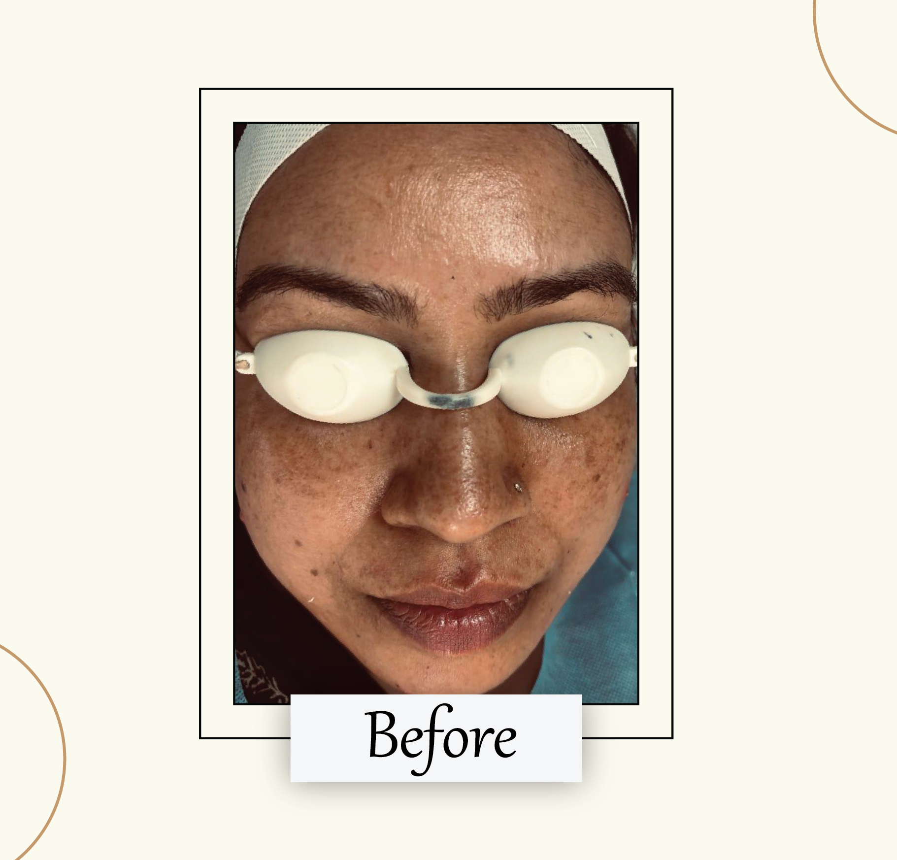 Before Chemical Peel
