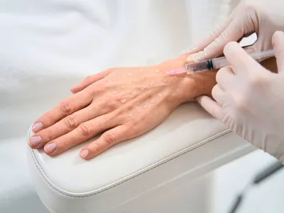 Hand Rejuvenation