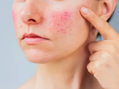 Rosacea Treatment
